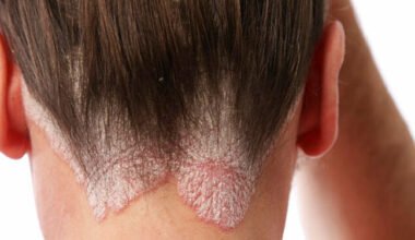 La psoriasis es una enfermedad crónica inflamatoria de la piel que generalmente se caracteriza por presentar piel enrojecida cubierta por una acumulación escamosa en cualquier parte del cuerpo.