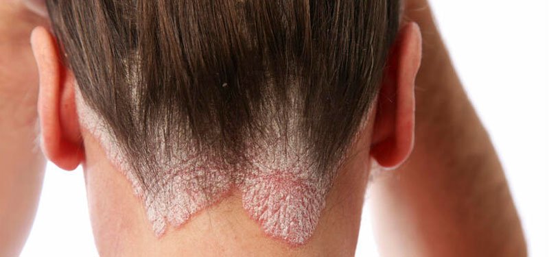 La psoriasis es una enfermedad crónica inflamatoria de la piel que generalmente se caracteriza por presentar piel enrojecida cubierta por una acumulación escamosa en cualquier parte del cuerpo.