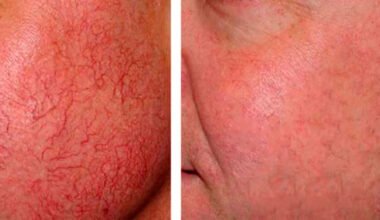 Como disminuir las aranas vasculares con remedios naturales