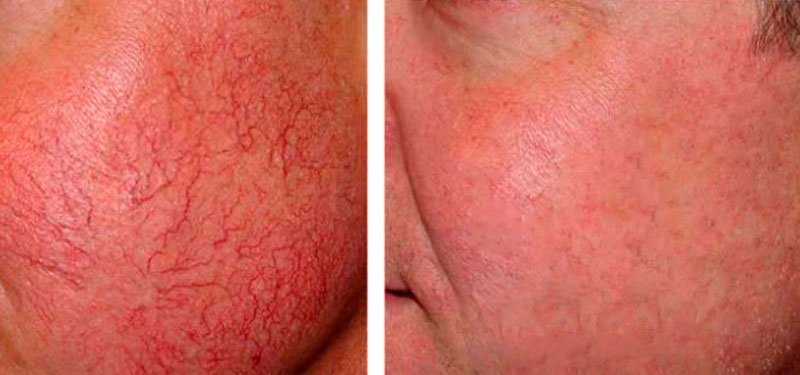 Como disminuir las aranas vasculares con remedios naturales