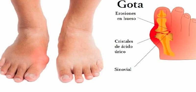 Como reducir el ácido úrico de manera natural